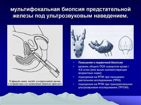 Основные показания к проведению массажа предстательной железы