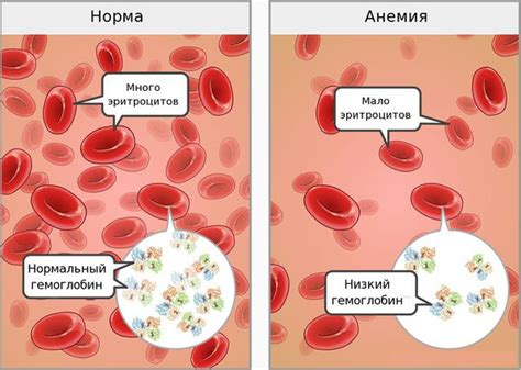 Основные причины развития анемии при избыточном содержании железа