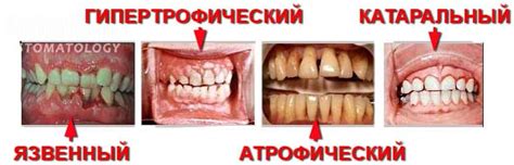 Основные симптомы гингивита