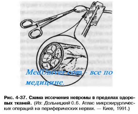 Открываем места обработки кости