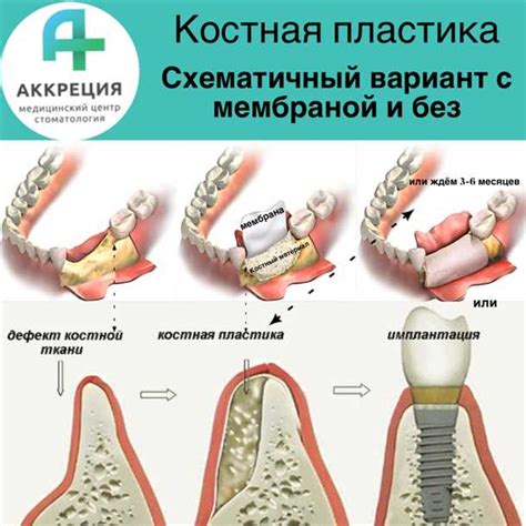 Повышение эстетического вида поверхности