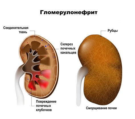 Поражение почек: