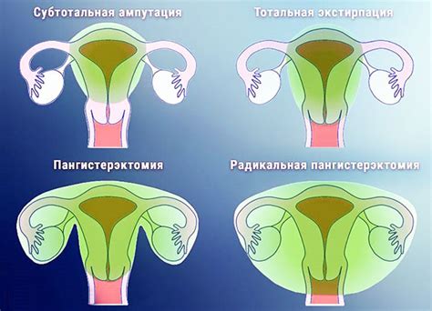 Последствия удаления сетхома