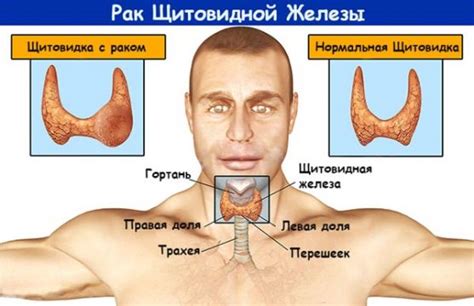 Последствия удаленной железы для образования и развития