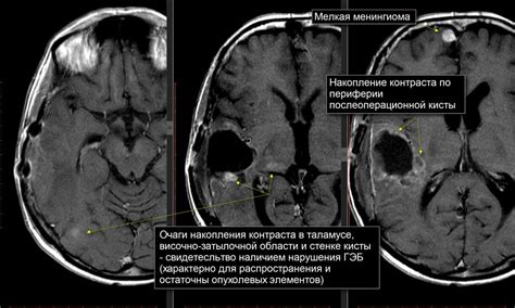 Предотвращение послеоперационной кисты