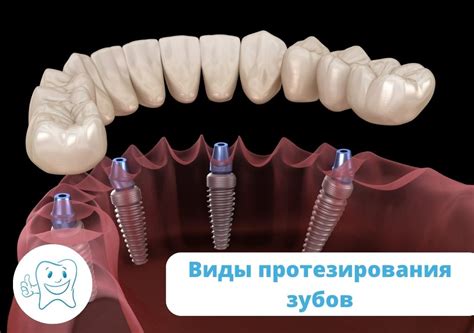 Преимущества и недостатки различных металлов для зубов