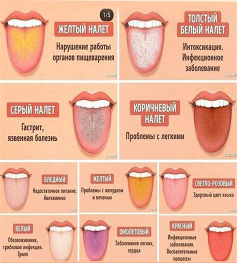 Прилипание языка к металлу: причины и механизм