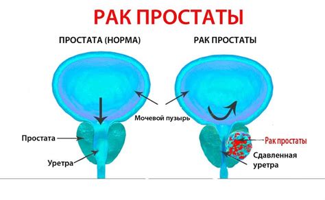 Причины возникновения абсцесса предстательной железы