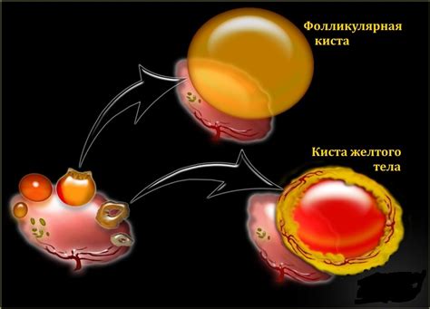 Причины образования и развития кисты