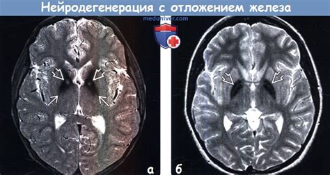 Причины ограничений по использованию металлов в МРТ