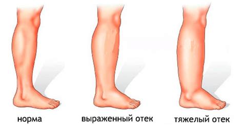 Причины постоперационных отеков ног