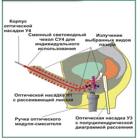 Причины узла на предстательной железе