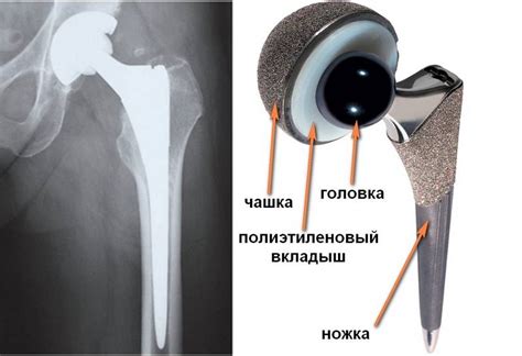 Протез тазобедренного сустава: основные виды и материалы