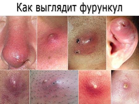 Профилактика и лечение фурункулов на грудной железе