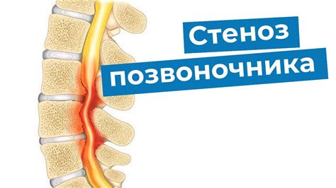 Разберитесь с деформацией и упругим возвращением