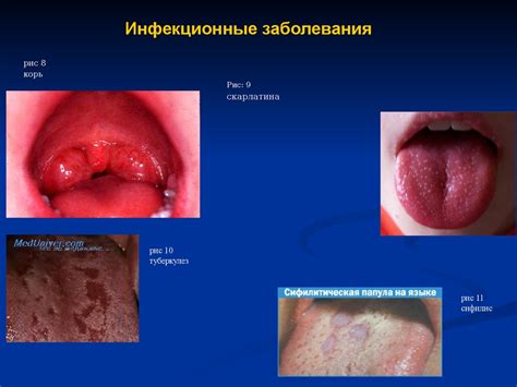 Раздражение слизистой оболочки рта: как дискомфорт попадает в жизнь