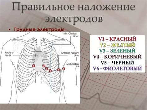 Расстановка электродов