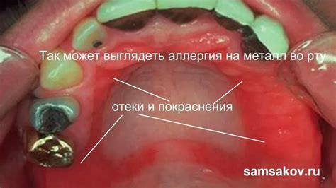 Симптомы аллергической реакции на металл