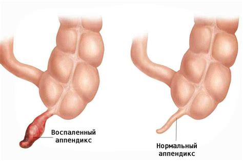 Симптомы и лечение аппендицита: важная информация