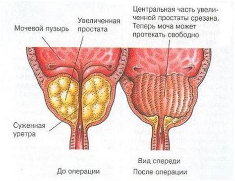 Симптомы и проявления рубцов на предстательной железе