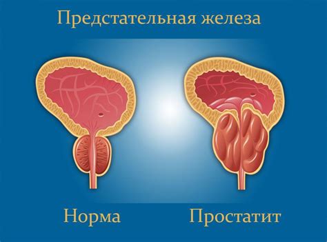 Стоит ли греть предстательную железу при воспалении?