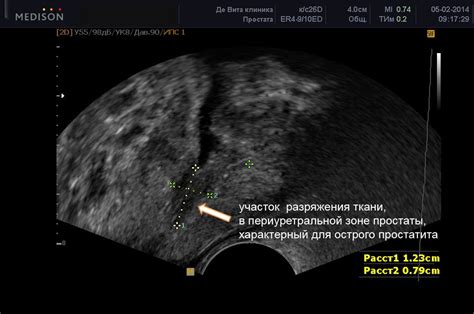 Суть исследования тканей предстательной железы