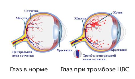 Технические методы удаления металлической частицы из глазной полости