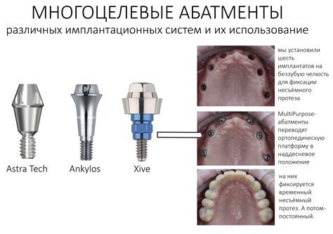 Типы металлических имплантов и их влияние на МРТ