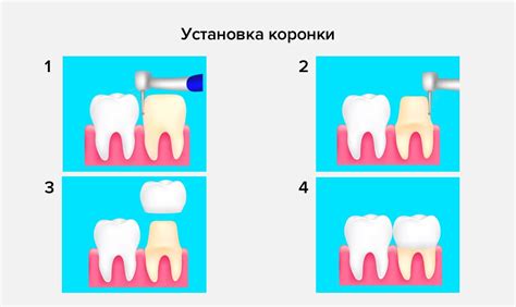 Точное соответствие размерам и материалу коронки