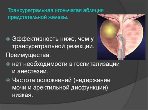 Трансуретральная игловая аблация предстательной железы