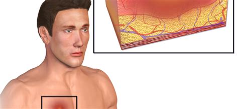 Фурункул на грудной железе: причины, симптомы и диагностика