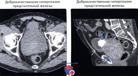 Хирургические методы лечения увеличенной предстательной железы