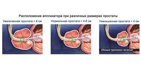 Хирургическое вмешательство при заболевании предстательной железы