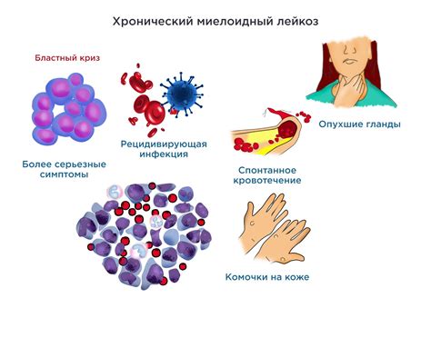 Хронический миелоидный лейкоз: описание и причины