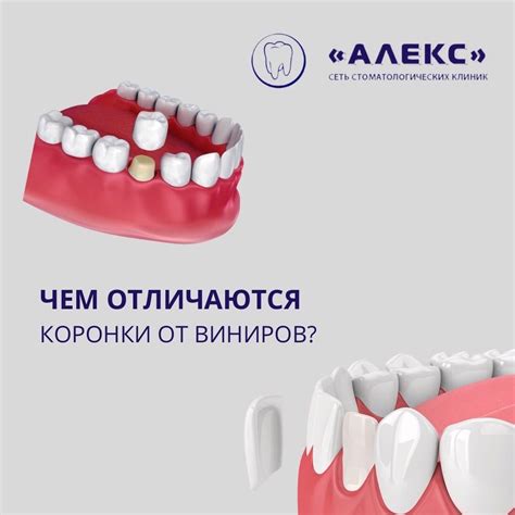 Чем отличаются профессиональные коронки от домашних