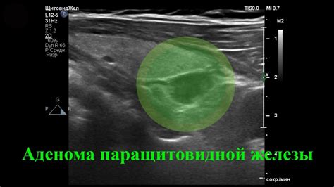 Что такое аденома паращитовидной железы?