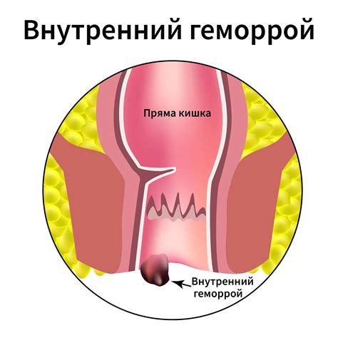 Что такое геморрой и каковы его основные симптомы