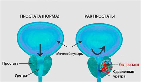 Что такое увеличенная предстательная железа