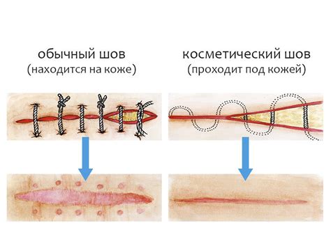 Швы смешанного типа