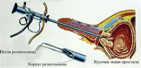 Эндоскопическая резекция предстательной железы: степень инвазивности и результаты