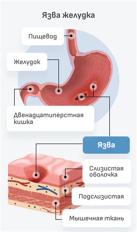 Язва желудка или двенадцатиперстной кишки