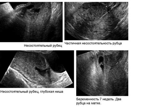  Диагностика увеличения железы на матке 